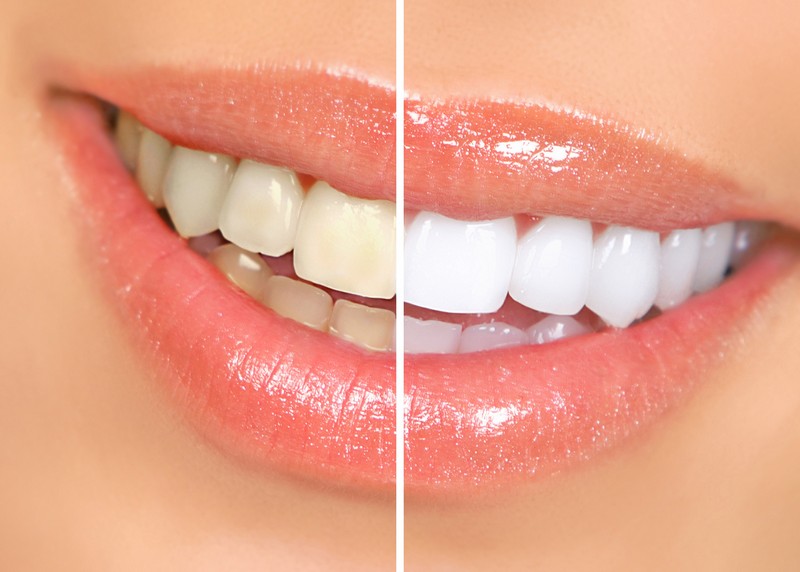 Teeth Whitening  Granada Hills, CA