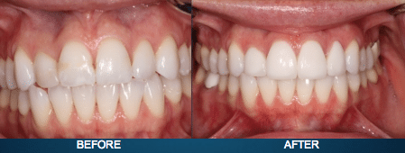 Veneers Granada Hills, CA